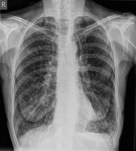 Emphysema