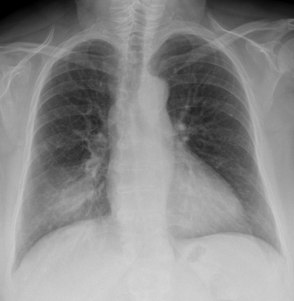 RLL Pneumonia
